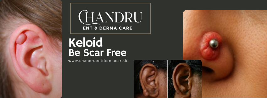 Keloid Scars: When a Small Wound Leaves a Bigger Mark