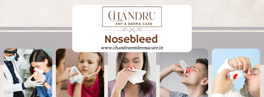Nosebleed? Don’t Panic — Know What to Do